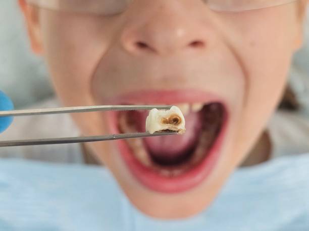 Best Emergency Tooth Extraction  in Ham Lake, MN